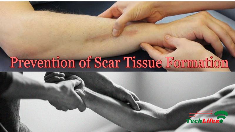 Prevention of Scar Tissue Formation